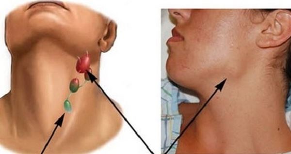 sưng hạch cổ có thể là triệu chứng của ung thư vòm họng